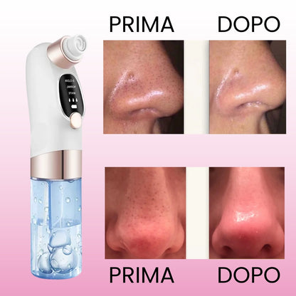 Aspiratore Punti Neri con Tecnologia ad Acqua